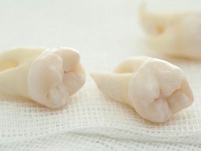 智齒疼了，這牙非拔不可嗎？