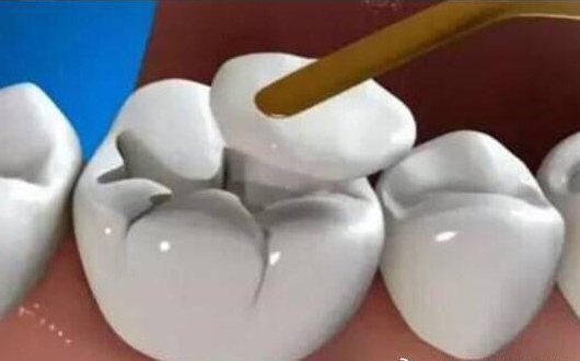樹(shù)脂補(bǔ)牙