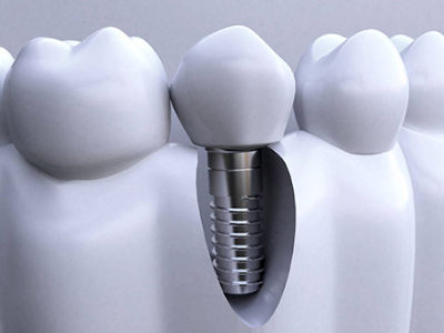 承德種植牙價格表，2024種植牙多少錢一顆呢?