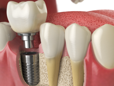 選擇種植牙后要做哪些日常維護(hù)？