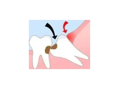 吃完飯后老塞牙？別大意！這可能是你的牙齒在報(bào)警