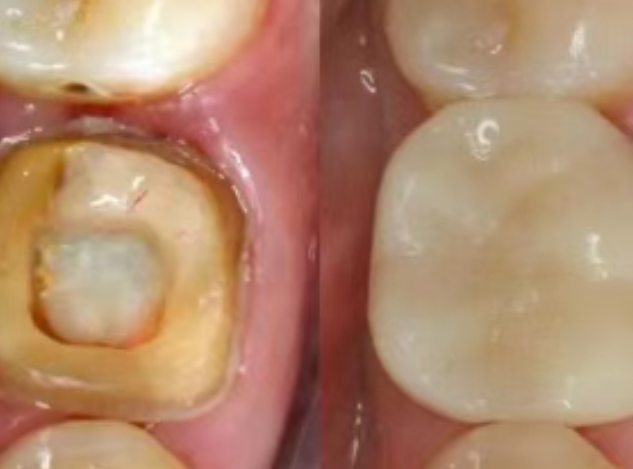 根管治療（抽神經(jīng)）后，為什么一定要做牙冠？