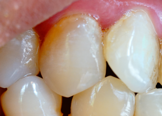 牙齒表面的牙釉質(zhì)掉了還可以修復(fù)嗎？