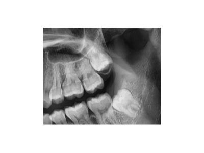 既然「智齒」不宜久留，為什么不能一次性拔掉？