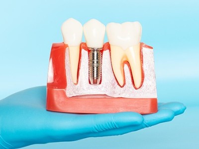 種牙VS鑲牙，你適合哪種?
