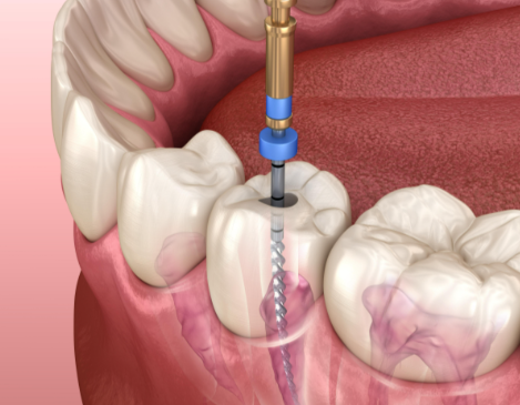 根管治療后的注意事項有哪些？